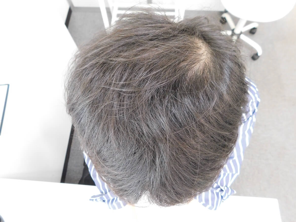 薄毛の改善事例（30代男性・6ヶ月後）