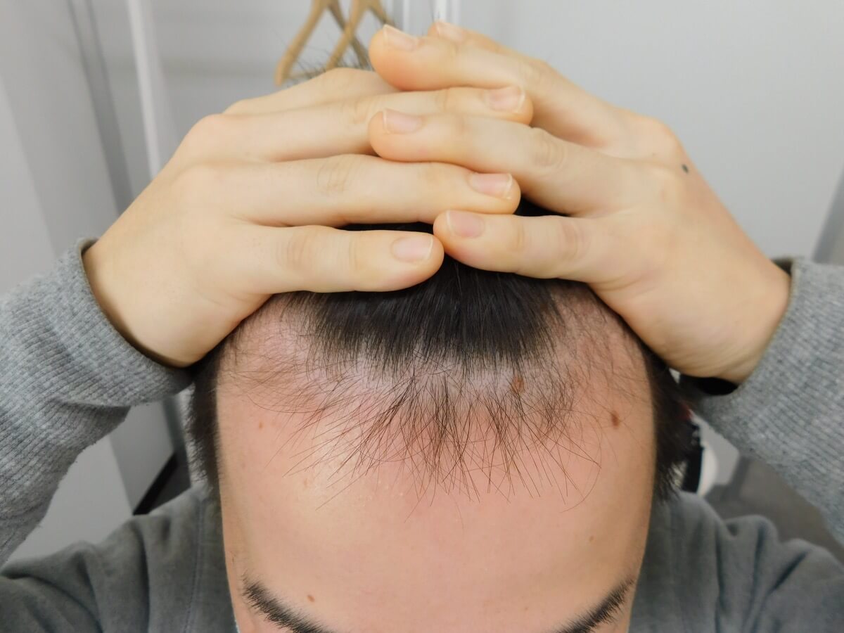 薄毛の改善事例（20代男性・来院時）