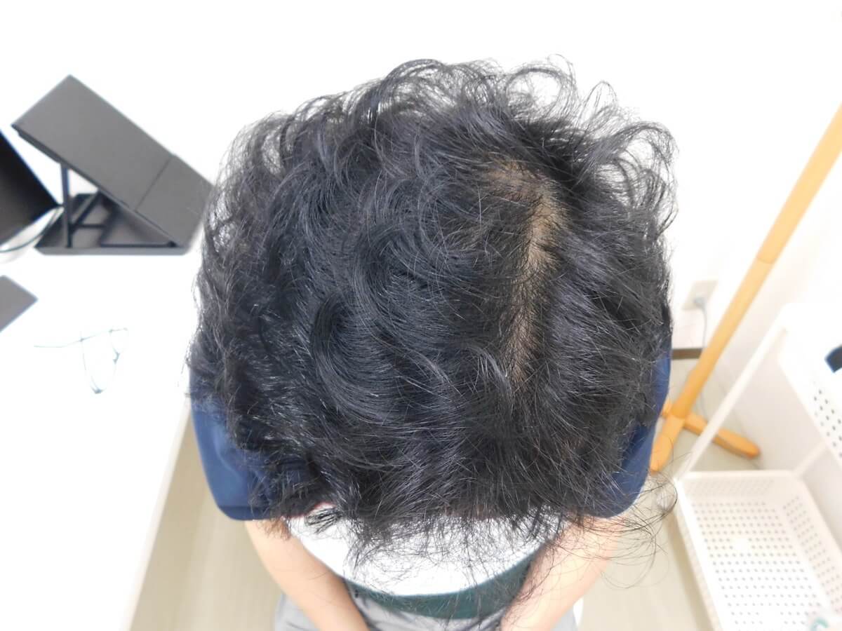 薄毛の改善事例（40代男性・10ヶ月後）