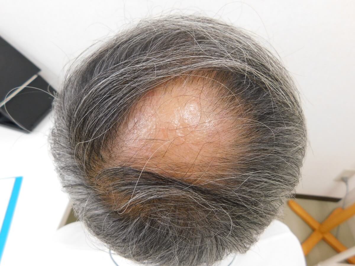 薄毛の改善事例（60代男性・来院時）