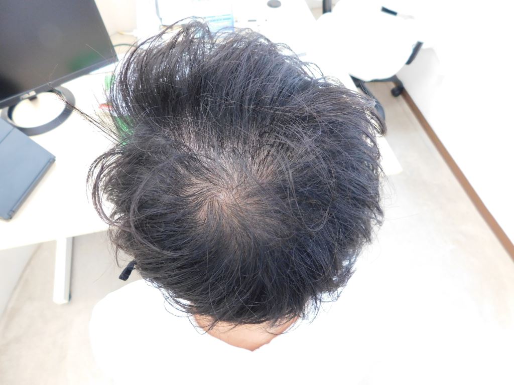 薄毛の改善事例（40代男性・来院時）